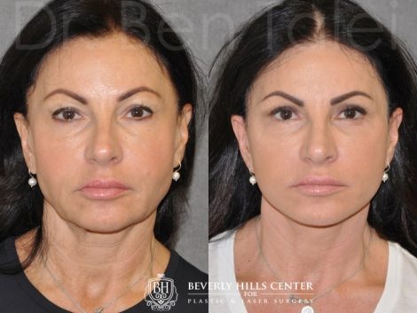 Beverly Hills Center Female Patient Before and After Auralyft with Upper and Lower Eyelid Rejuvenation