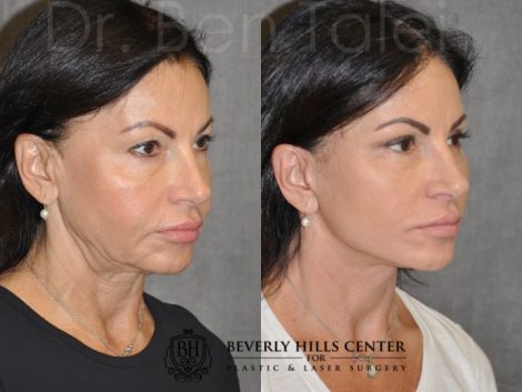 Beverly Hills Center Female Patient Before and After Auralyft with Upper and Lower Eyelid Rejuvenation