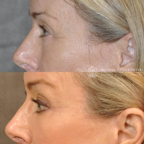 Beverly Hills Center Female Patient Before and After Facial Rejuvenation Procedures