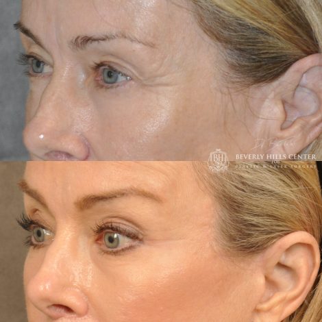 Beverly Hills Center Female Patient Before and After Facial Rejuvenation Procedures