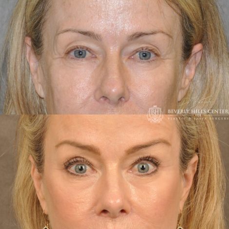 Beverly Hills Center Female Patient Before and After Facial Rejuvenation Procedures