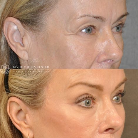 Beverly Hills Center Female Patient Before and After Facial Rejuvenation Procedures