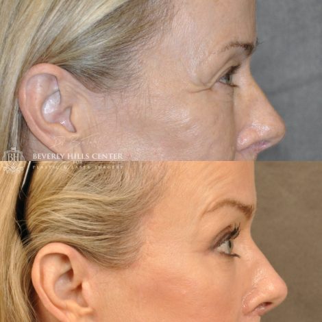 Beverly Hills Center Female Patient Before and After Facial Rejuvenation Procedures