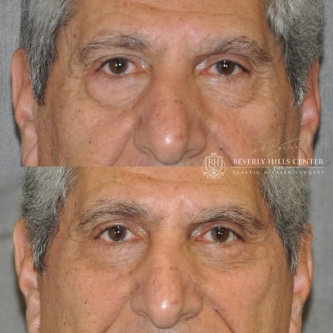 Beverly Hills Center Male Patient Before and After Lower Eyelid Tightening Procedure