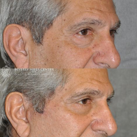 Beverly Hills Center Male Patient Before and After Lower Eyelid Tightening Procedure