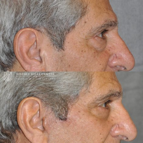 Beverly Hills Center Male Patient Before and After Lower Eyelid Tightening Procedure