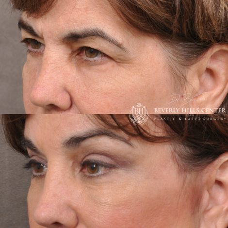 Beverly Hills Center Female Patient Before and After AuraLyft, Browlift & Blepharoplasty Procedures
