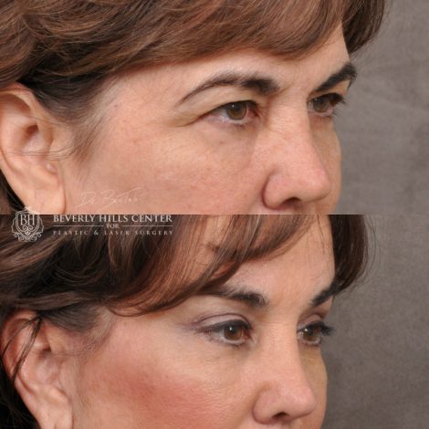 Beverly Hills Center Female Patient Before and After AuraLyft, Browlift & Blepharoplasty Procedures