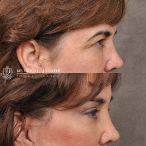 Beverly Hills Center Female Patient Before and After AuraLyft, Browlift & Blepharoplasty Procedures
