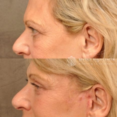 Beverly Hills Center Female Patient Before and After Browlift, Upper & Lower Eyelid Rejuvenation