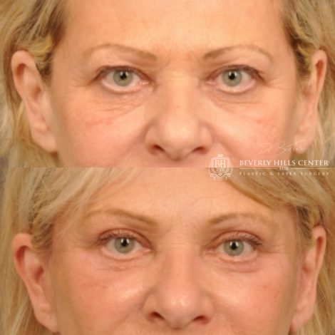 Beverly Hills Center Female Patient Before and After Browlift, Upper & Lower Eyelid Rejuvenation