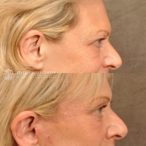 Beverly Hills Center Female Patient Before and After Browlift, Upper & Lower Eyelid Rejuvenation