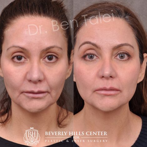Beverly Hills Center Female Patient Before and After Profound RF Treatment