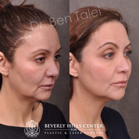 Beverly Hills Center Female Patient Before and After Profound RF Treatment
