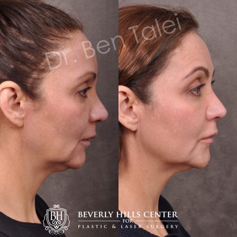 Beverly Hills Center Female Patient Before and After Profound RF Treatment