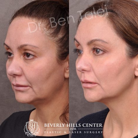 Beverly Hills Center Female Patient Before and After Profound RF Treatment