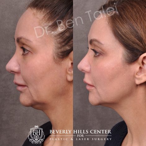 Beverly Hills Center Female Patient Before and After Profound RF Treatment
