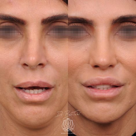 Beverly Hills Center Female Patient Before and After Revision Rhinoplasty and Lip Lift Procedure