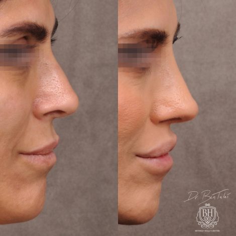 Beverly Hills Center Female Patient Before and After Revision Rhinoplasty and Lip Lift Procedure