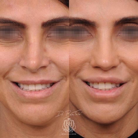 Beverly Hills Center Female Patient Before and After Revision Rhinoplasty and Lip Lift Procedure