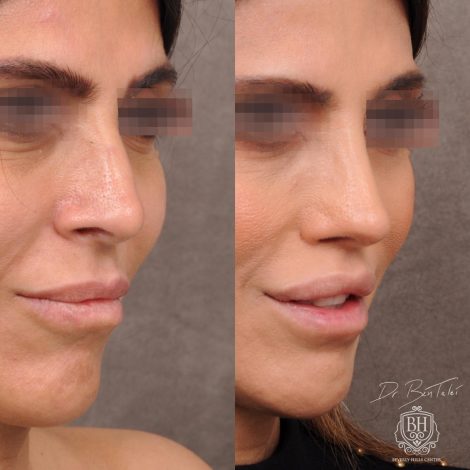 Beverly Hills Center Female Patient Before and After Revision Rhinoplasty and Lip Lift Procedure