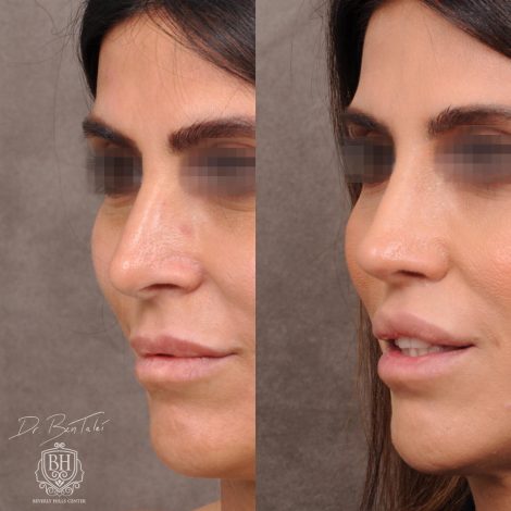 Beverly Hills Center Female Patient Before and After Revision Rhinoplasty and Lip Lift Procedure