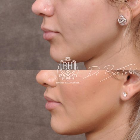 Beverly Hills Center Female Patient Before and After Deep Plane Modified Upper Lip Lift