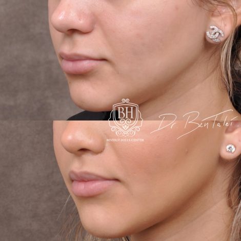 Beverly Hills Center Female Patient Before and After Deep Plane Modified Upper Lip Lift