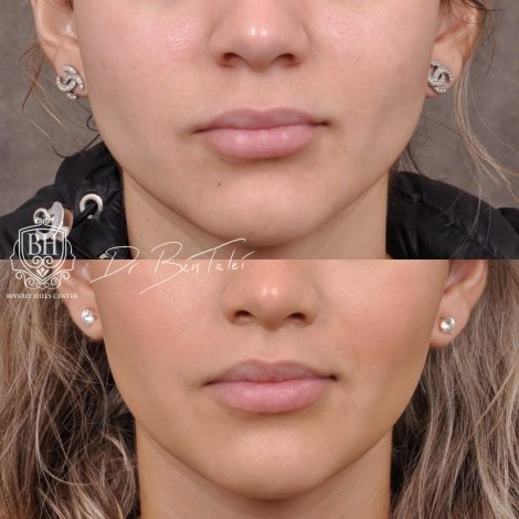 Beverly Hills Center Female Patient Before and After Deep Plane Modified Upper Lip Lift