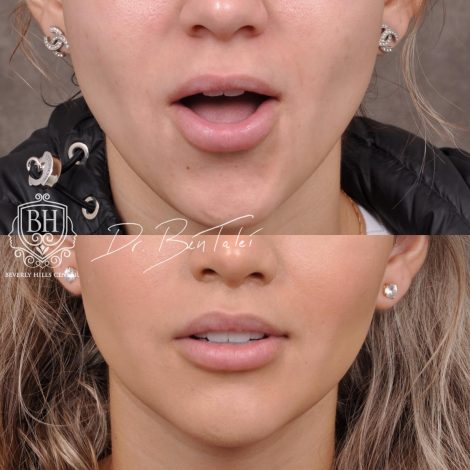 Beverly Hills Center Female Patient Before and After Deep Plane Modified Upper Lip Lift