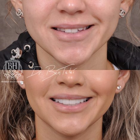 Beverly Hills Center Female Patient Before and After Deep Plane Modified Upper Lip Lift