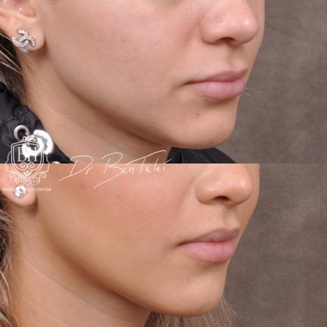 Beverly Hills Center Female Patient Before and After Deep Plane Modified Upper Lip Lift