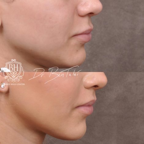 Beverly Hills Center Female Patient Before and After Deep Plane Modified Upper Lip Lift