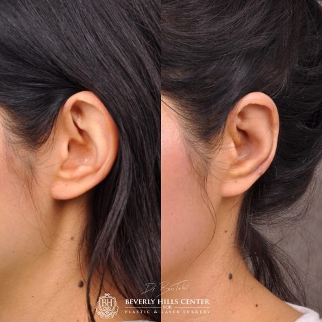 Beverly Hills Center Female Patient Before and After Otolasty/Ear Reshaping