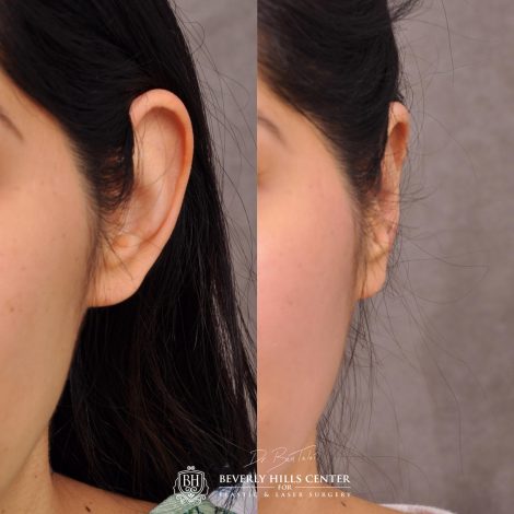 Beverly Hills Center Female Patient Before and After Otolasty/Ear Reshaping