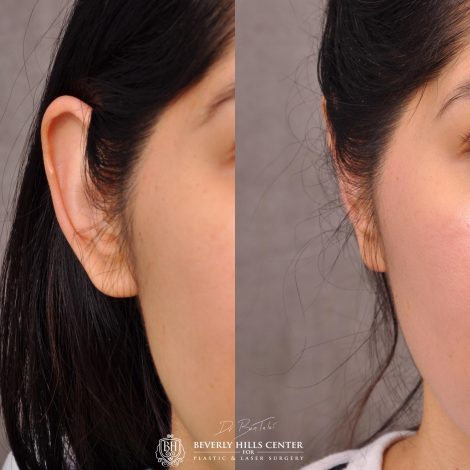 Beverly Hills Center Female Patient Before and After Otolasty/Ear Reshaping