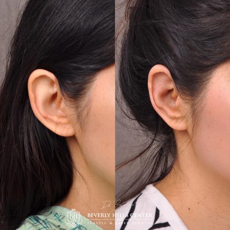 Beverly Hills Center Female Patient Before and After Otolasty/Ear Reshaping