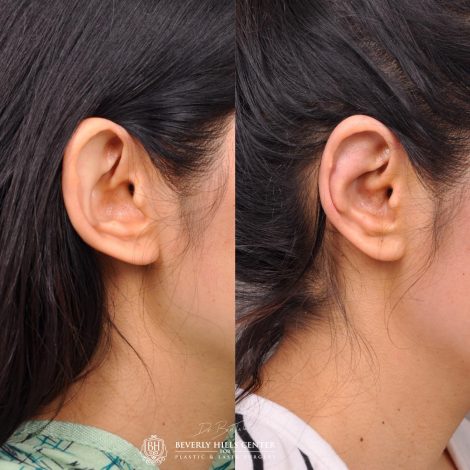 Beverly Hills Center Female Patient Before and After Otolasty/Ear Reshaping