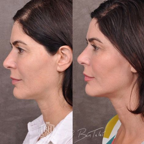 Beverly Hills Center Female Patient Before and After Profound RF