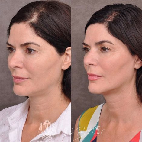 Beverly Hills Center Female Patient Before and After Profound RF