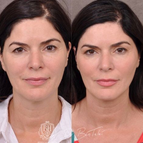 Beverly Hills Center Female Patient Before and After Profound RF
