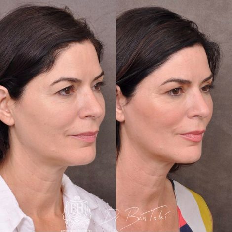 Beverly Hills Center Female Patient Before and After Profound RF