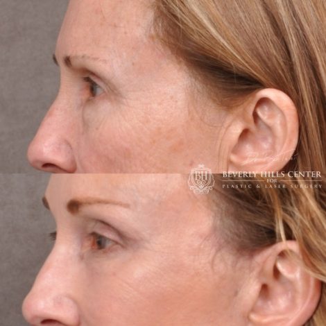 Beverly Hills Center Female Patient Before and After AuraLyft with Upper Blepharoplasty Procedure