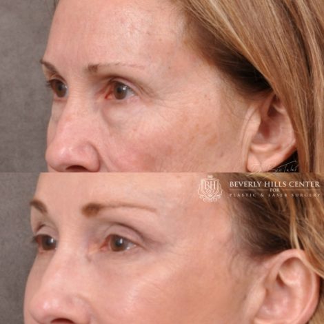 Beverly Hills Center Female Patient Before and After AuraLyft with Upper Blepharoplasty Procedure