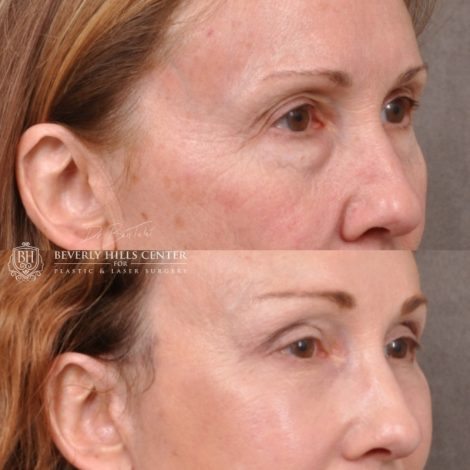 Beverly Hills Center Female Patient Before and After AuraLyft with Upper Blepharoplasty Procedure