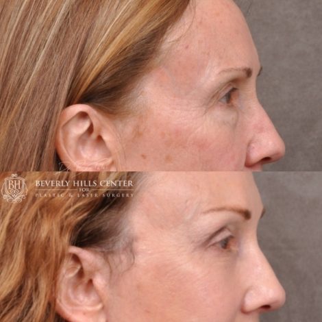 Beverly Hills Center Female Patient Before and After AuraLyft with Upper Blepharoplasty Procedure