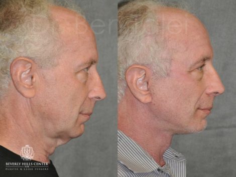 Beverly Hills Center Male Patient Before and After Awake and Painless AuraLyft Procedure