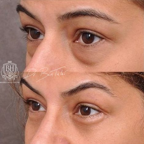 Beverly Hills Center Female Patient Before and After Rhinoplasty and Lower Eyelids