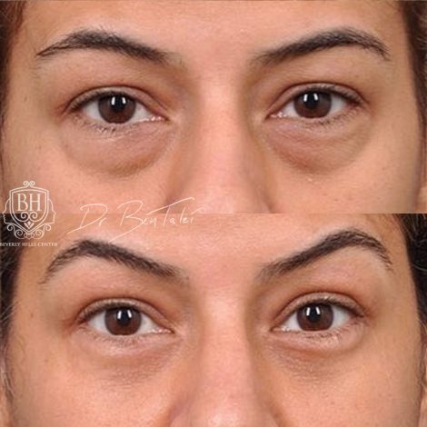 Beverly Hills Center Female Patient Before and After Rhinoplasty and Lower Eyelids