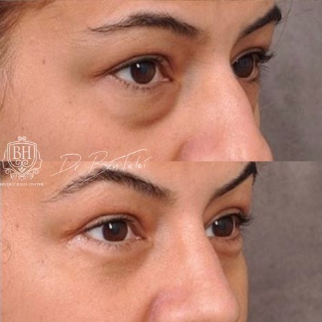 Beverly Hills Center Female Patient Before and After Rhinoplasty and Lower Eyelids